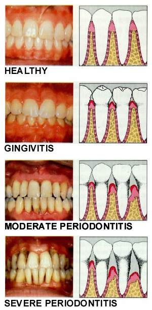 What are the symptoms of periodontal gum disease?