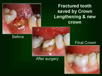Dental Crowns