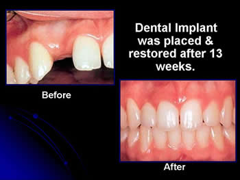 Dental Implants