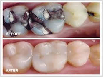 Dental Onlay