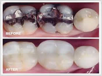 Dental Onlays