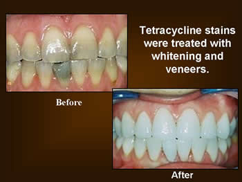 Dental Teeth Whitening